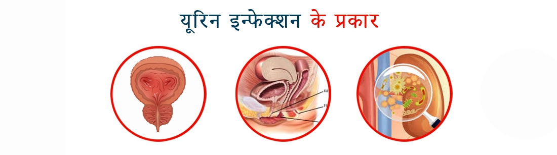 Types of Urinary Tract Infection in Hindi